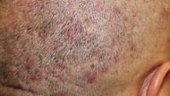 Scalp scabs (Image via Getty Images)